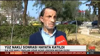 Yüz nakli sonrası hayata katıldı