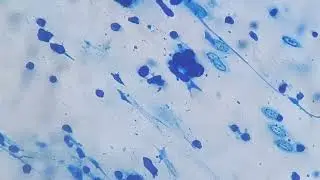 Bronchoalveolar lavage in LPCB preparation for fungal examination