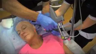 Micro Laser Peel - Acne Treatment, Remove Wrinkles, or Eliminate Sun Spots - LRVLC