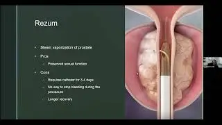 Wellness Webinar: Enlarged Prostate in Aging Men
