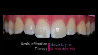 Resin Infiltration Therapy with ICON for White Spot Lesions