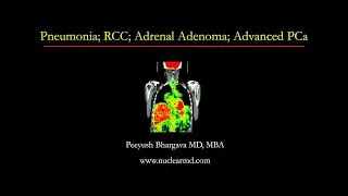 Pneumonia; RCC; Adrenal Adenoma; Advanced PCa