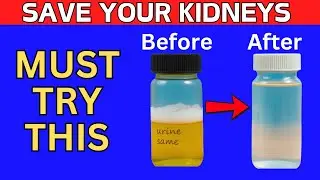 Top 6 Super Foods To Help Stop Proteinuria and Heal Your Kidneys