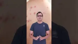What is Monkeypox And How Dangerous Is It? | One Minute with Aashish Kushwah | Embibe