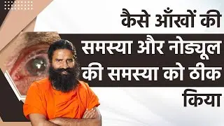 कैसे आँखों की समस्या (Eye Problems)और नोड्यूल की समस्या (Nodule Problems) को ठीक किया | Swami Ramdev