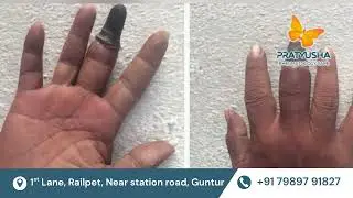 What is Scleroderma Symptoms & Diagnosis Explained in Telugu | PRATYUSHA RHEUMATOLOGY CARE