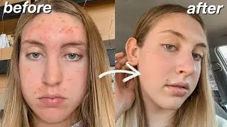 HOW I CLEARED MY SKIN IN 30 DAYS! *acne transformation*