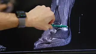 Conquer Your Pain: Overcoming Achilles Tendonitis
