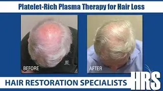 PRP for Hair Loss at Hair Restoration Specialists of Atlanta