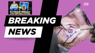 Baby Boomer BEATS The Odds - Extreme Weight Loss-Now New Eyes