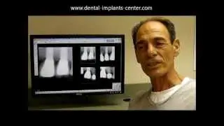 Sinus Graft Dental Implants Tijuana Mexico