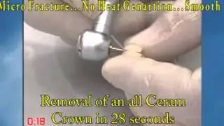 Strauss Ceramic bur clinic version