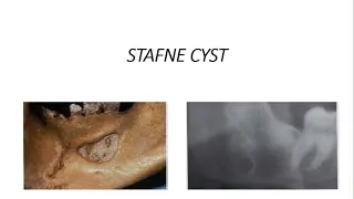 STAFNE CYST