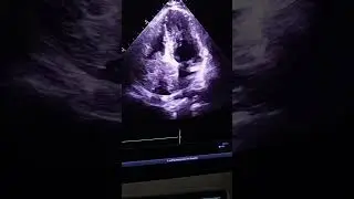 RA myxoma #echocardiography #cardiology #cardiologycare #shortsfeed #shortvideo