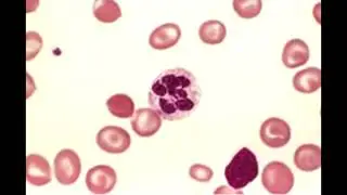 Megaloblastic Anemia - Macrocytic Anemia (overview)