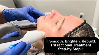 TriFractional Step by Step - The Derma Lounge, Aurora 🤍