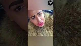 Hot Lips Surgery gone wrong | Plastic surgery reactions #factrn #shorts #viral #shortsvideo