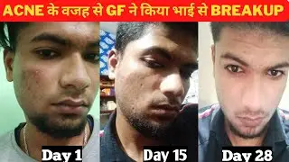 blackheads , whiteheads , acne skin transformation | glow with shubham skin transformation plan
