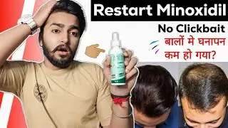 Restart Using Minoxidil No Clickbait | Again Start Minoxidil | Sahil Nagpal