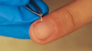 Безболезненное удаление заусенцев