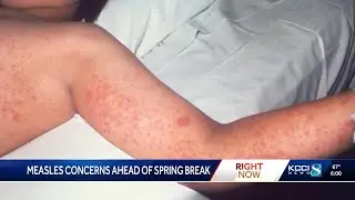 Measles outbreak in the South raises concerns in Iowa