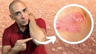 JÁ VIU ESSA LESÃO EM ALGUÉM? PSORÍASE ASSISTE ESSE VÍDEO AGORA! | Dr Dayan Siebra #feridas