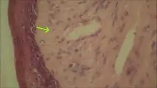 Fibroma