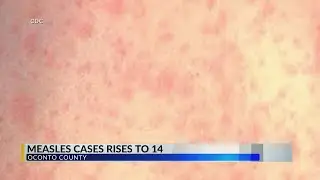 Wisconsin DHS: Additional measles cases confirmed in Oconto County, urge to check vaccination status