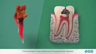 ESE Video - VITAL PULP TREATMENT / СОХРАНЕНИЕ ЖИЗНЕСПОСОБНОСТИ ПУЛЬПЫ (русский перевод)