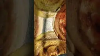 Dosa😋Subscribe to my channel❤ #paperdosa #spicydosa #spinachdosa #gheedosa #homemade #shorts