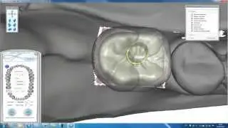 Couronne sur Implant - mod&egrave;le non fractionn&eacute;