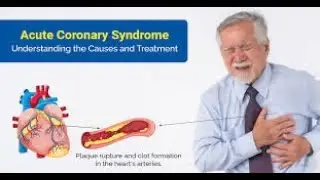 ESC GUIDELINES ON ACUTE CORONARY DISEASE/WACP