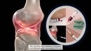 Wie funktioniert die Stammzelltherapie mit Fettzellen bei Arthrose?