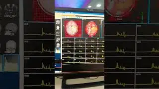 MRI Brain #spectroscopy processing