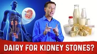 Should You Eat Dairy (Calcium) With Kidney Stones? Food For Kidney Stones &ndash; Dr. Berg