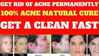 Acne No More Reviews-Acne No More Bonus-Acne No More Book By Mike Walden-Acne No More Secrets Series