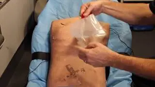 Chest Seal