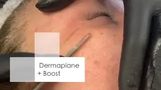 Why AHA:BHA Boosts Take Your Dermaplane to the Next Level