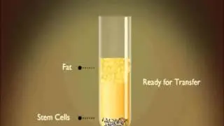 Stem Cell Therapy in Thailand by Adistem System at Yoskarn Clinic