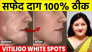 Safed Daag Ka Ilaj Kaise Karen | Vitiligo Skin Disease Treatment | Acupressure Points
