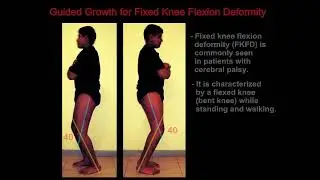 Guided Growth for Fixed Knee Flexion Deformity