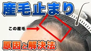 AGA治療薬を飲んでもM字が産毛止まり。生えない理由と解決方法！