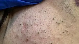 Maya Facial Care Routine (Say Goodbye to Pimples & Blackheads)