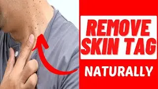 Best Skin Tag Removal Product Reviews | Skin Tag Removal Product That Really Works