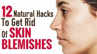 12 Natural Hacks To Get Rid Of Skin Blemishes | Healthspectra