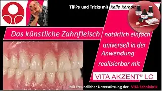 Das künstliche Zahnfleisch individualisieren mit VITA Akzent LC