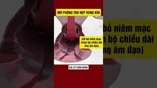 M&ocirc; phỏng 3D thu hẹp chem ch&eacute;p chuẩn