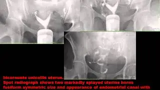 CASE 119 BICORNUATE UTERUS HSG