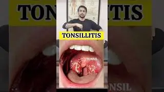 Best Exercise for Tonsillitis Relief #shortvideo #shorts #tranding #exercise