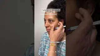 Selfie Update: 1 Year After Trifecta Lift | Dr. Kami Parsa | Puffy Eye Bag Treatment